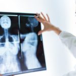 Tratare cancer de sân